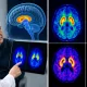 Parkinson Hastalığında Tanı